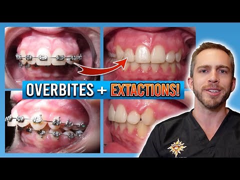 Braces Overbite Treatment! [BEFORE & AFTER]
