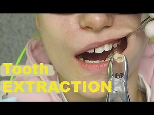 Primary Tooth Extraction