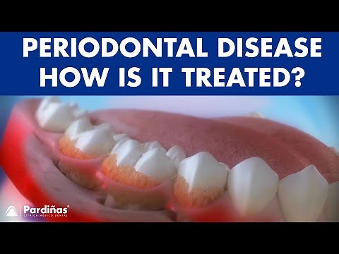 Periodontitis and its influence on health - How is periodontal disease treated? ©