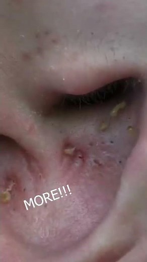 Blackheads in ears,cysts extractions this week,huge black head//PIMPLE POPPING TIKTOK#shorts#acne