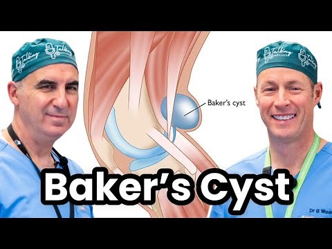 Understanding and Treating Baker's Cyst