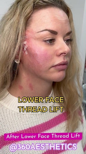 PDO Thread Lift for Lower Face: Cost, Procedure, and Benefits