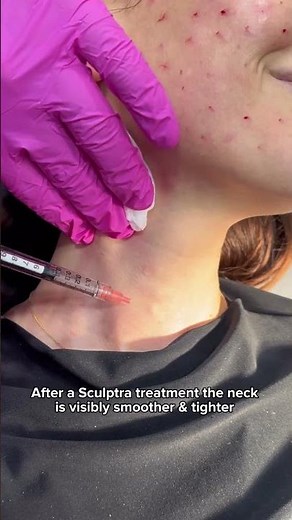 Neck Rejuvenation with Sculptra | Dr. Medispa