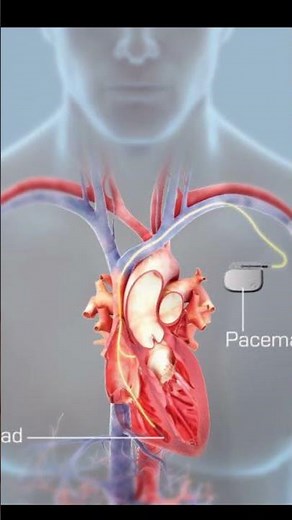Pacemakers explained,How Pacemaker Implanted #shorts