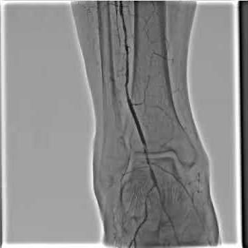 Angiography - Lower Extremities RSM-DSA