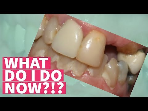 HELP...I Broke My Tooth