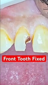 Fixing a Front Tooth Cavity with Composite Resin