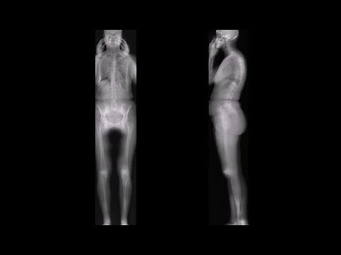 Radiographie 3D / Squelette humain