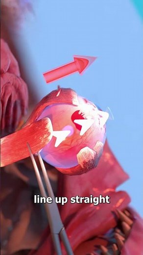 How Strabismus Eye Surgery Works 🤔