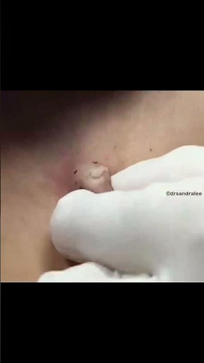 Here is an example of a cyst extraction using a Punch Excision Tool
