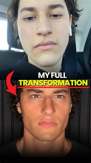 How I Naturally Transformed #health #looks #oscarpatel #habits - This content is for educational and informational purposes only and reflects what we have learned through years of client experience. It is not medical advice, diagnosis, or treatment, and is not a substitute for guidance from a qualified healthcare professional. Everything shared here is general information about structural health and facial development, not personalised advice for your specific situation. Always consult a doctor 