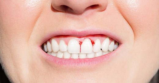 Bleeding Gums: Causes, Treatments, Cures and Prevention - Dentaly.org