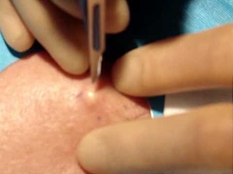 Skin surgery - epidermoid (sebaceous) cyst removal 1