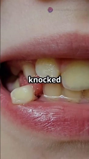 What to Do When tooth Fall Out After an Accident? #avulsion