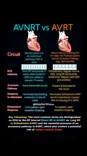 🔍 AVNRT vs. AVRT: Cheat Sheet Master the critical differences between the two most common SVTs. Save this for your next code or rounds! Like & Share to educate your network! 🔁 #Cardiology #EPeeps #SVT #ECG #MedTwitter #FOAMed #MedEd | Abdallah Othman