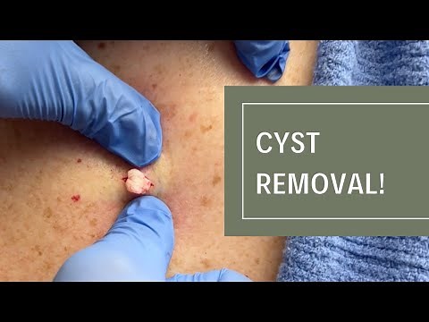 Cyst Removal! | Dr. Derm