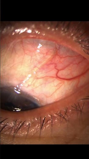 Glaucoma Surgery: Ahmed Valve