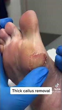 Uncover smooth skin beneath! Watch this drastic callus removal by our expert podiatrist