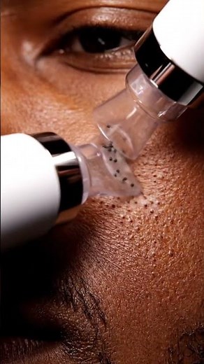 “Vacuum vs Blackheads — One Swipe Clean!”