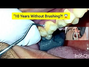 Tartar removal | Deep Dental Cleaning | Broken Tooth Extraction |