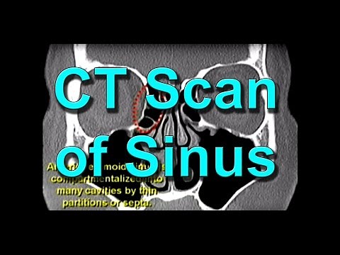 How To Read CT Sinus Scans Like An Expert