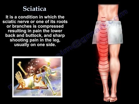 Sciatica - Everything You Need To Know - Dr. Nabil Ebraheim