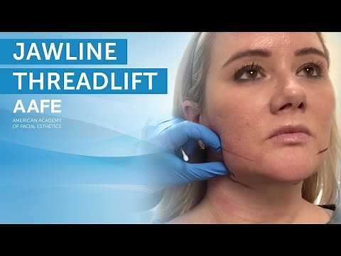 Creating a Snatched Jawline with PDO Threadlifts | AAFE