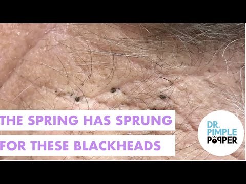 Spring Has Sprung for Blackheads