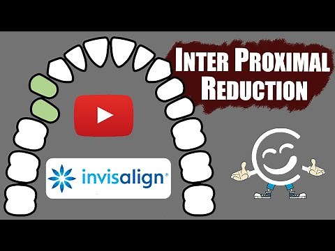 Inter Proximal Reduction (IPR) For Invisalign Treatments