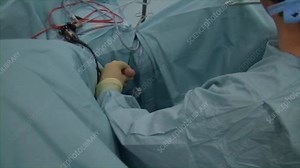 TURP biopsy procedure - Stock Video Clip - K003/8580