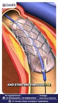 CTO Treatment Explained | Advanced Stenting with Imaging Catheters | Dr. Lakkireddy | CTO