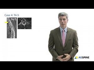 AOSpine Thoracolumbar Classification System