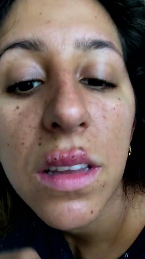 Cystic acne and blackheads removal - Newest pimple pops for 2022