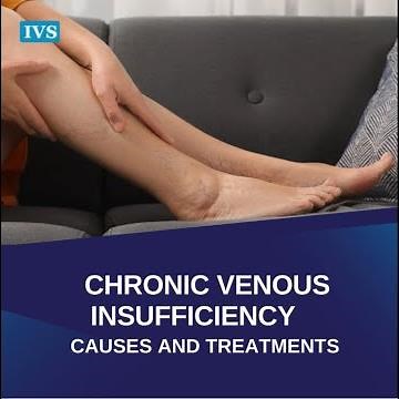 Chronic Venous Insufficiency - Causes And Treatments