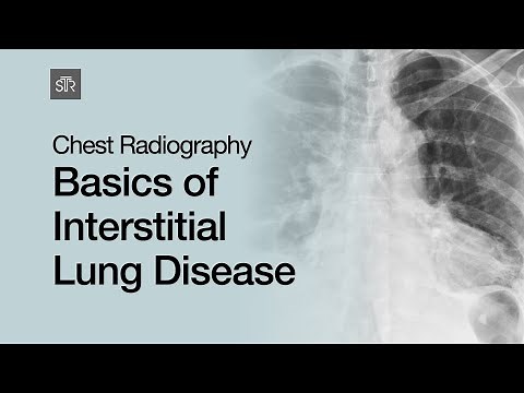 Chest Radiography: Basics of Interstitial Lung Disease