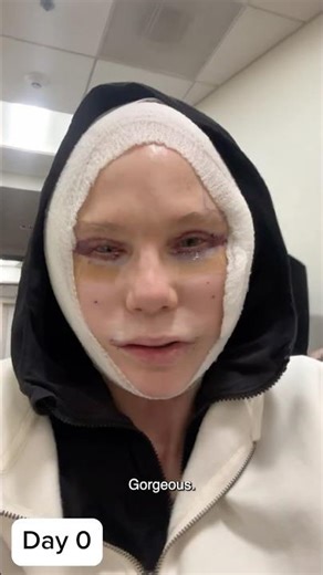 6-Month Facelift Results That Will Surprise You! 59-Year-Old Cindy's Healing Journey Transformation