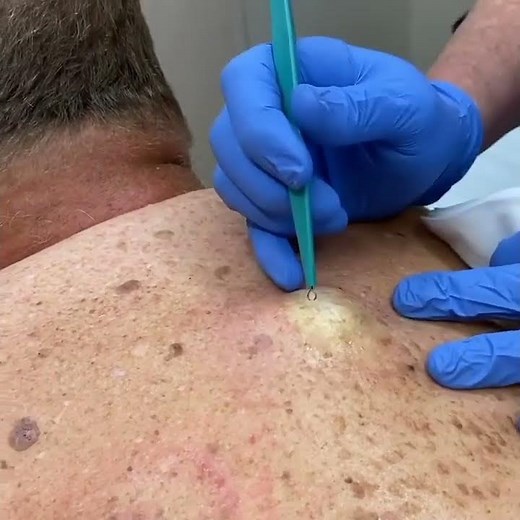 Pimple popping, cyst Popping for this week, blackheads, whiteheads, acne, zits, popping