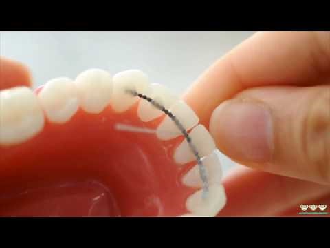 How to floss under your fixed retainer wire | Evolution Orthodontics