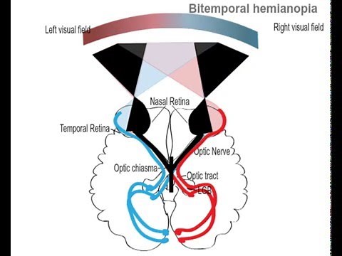 Bitemporal hemianopia