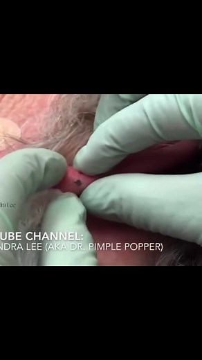 Ear blackheads are the best kind… #drpimplepopper compilation | pimple popper