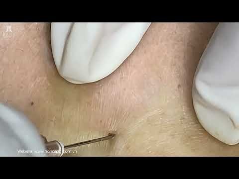 Big Cystic Acne Blackheads Extraction Blackheads & Milia, Whiteheads Removal Pimple Popping