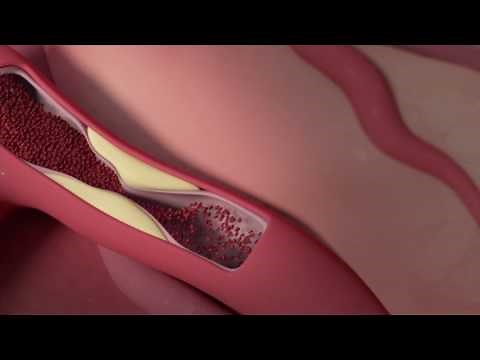 What is a coronary angiogram