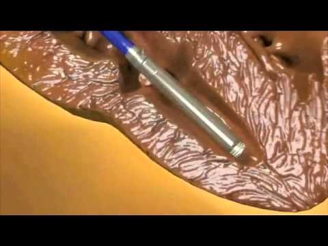 Leadless Cardiac Pacemaker | NEJM