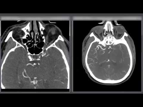 Large Artery Occlusion - ICA