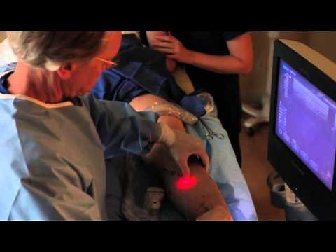 (EVLT) Endovenous Laser Treatment