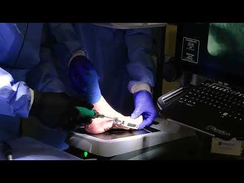 PROstep MIS MICA SOLO Cadaver- Dr. Steven Steinlauf