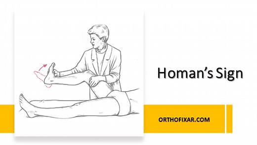Homans Sign Test Explained Easily | OrthoFixar