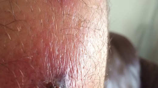 Brown Recluse Spider Bite Time Lapse Progression