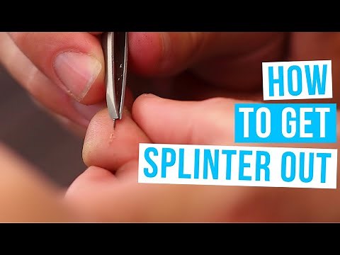 How to GET A SPLINTER OUT | Get rid of splinters with or without tweezers