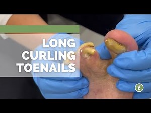 LONG CURLING TOENAILS! !